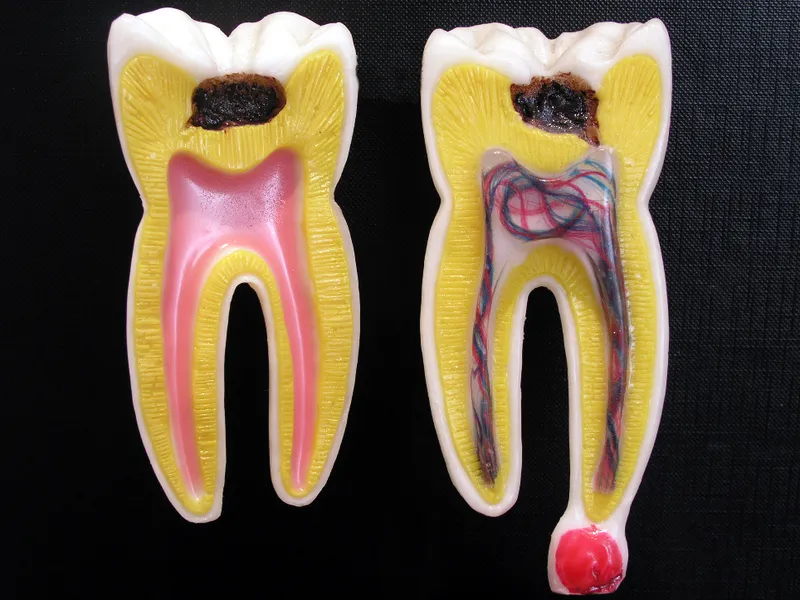Plaga de CARIES, TILLETIA CONTROVERSA